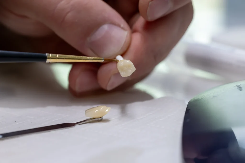 Veneers aus Keramik werden im eigenen Meisterlabor individuell bemalt